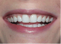 Bleaching and Adhesive Bonding to Whiten Teeth and Close Gap