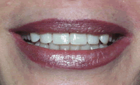 Bleaching Crown Replacement to Whiten Teeth and Improve Smile