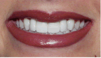 Bleaching and Crown Replacement to Whiten Teeth and Improve Smile