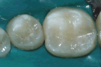 Decay in Cavity Repaired with Tooth Colored Adhesive Bonding