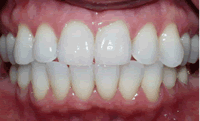 Teeth Whitened, Straightened with Minimal Bonding